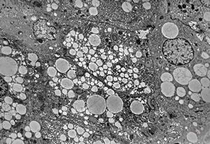 F,1y. | steatosis - Reye hepatocerebral syndrome F,1y. | steatosis - Reye hepatocerebral syndrome